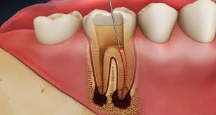 Điều trị tủy răng bằng máy vi phẫu hiện đại