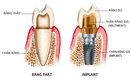 Cấy ghép Implant là gì? Ưu nhược điểm của trồng răng Implant