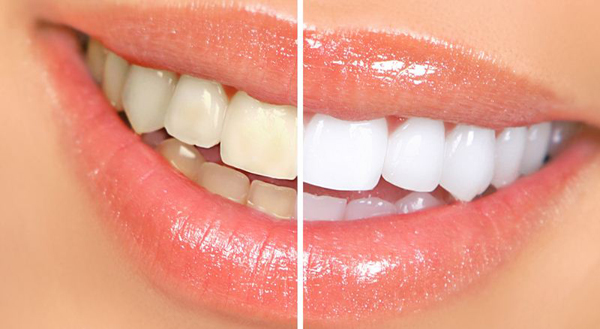 Cách làm trắng răng hiệu quả bất ngờ bằng 8 mẹo nhỏ