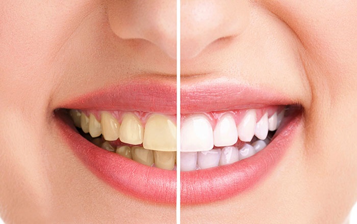 Tại sao cần phải cạo vôi răng?