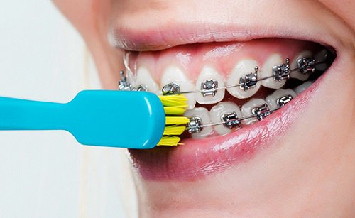 8 lưu ý khi niềng răng bác sĩ khuyên bạn nên tránh