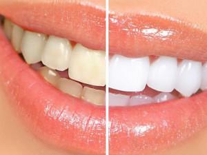 Nha khoa Quốc tế Vip Dentist ưu đãi lớn chỉ từ 10,000,000tr / hàm...