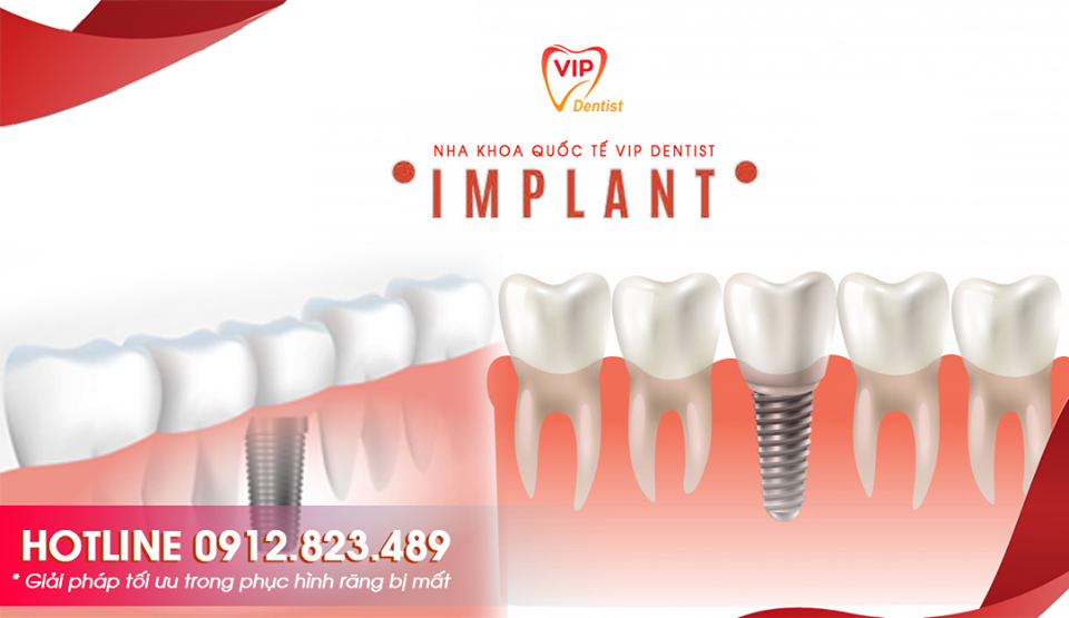 Cắm IMPLANT - Giải pháp tối ưu cho phục hình Răng bị mất