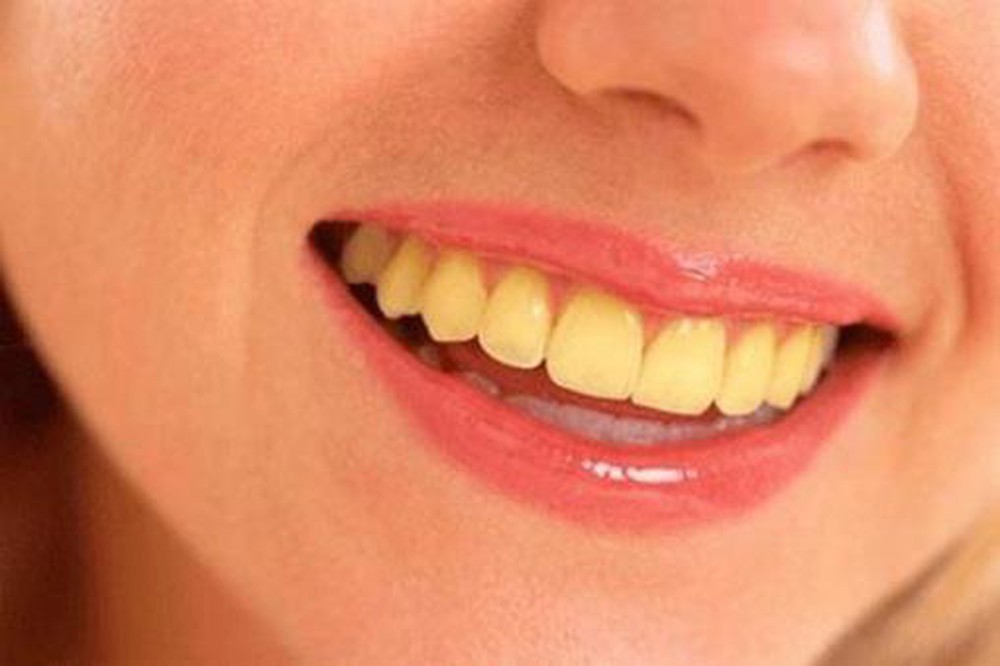 Ám ảnh của bạn khi răng bỗng dưng vàng ố