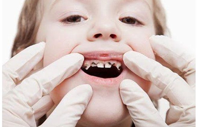 Những thói quen “sướng miệng nhưng hại răng” bạn cần bỏ ngay