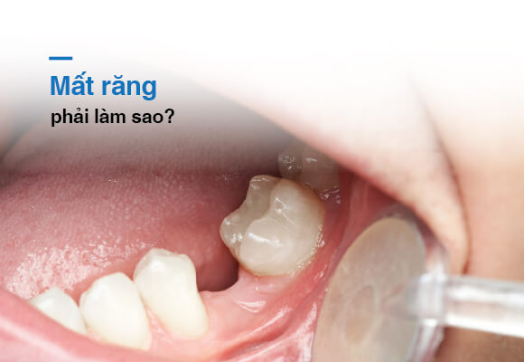 3 tình trạng thường gặp ở người mất răng nguyên hàm