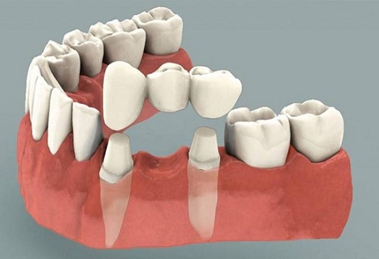 Người mất răng nên làm cầu răng hay Implant?