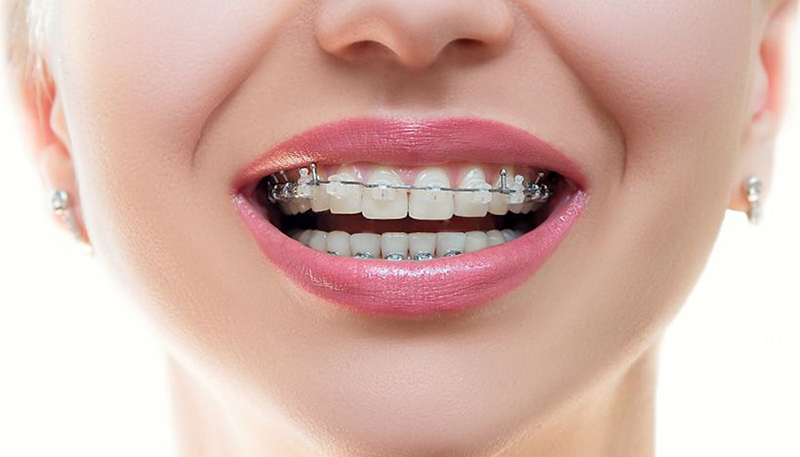 Khi niềng răng, bạn nên ăn uống như thế này nha