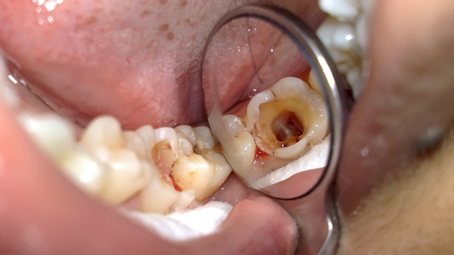 Viêm tủy răng – Căn bệnh rình rập những bạn “hảo ngọt”