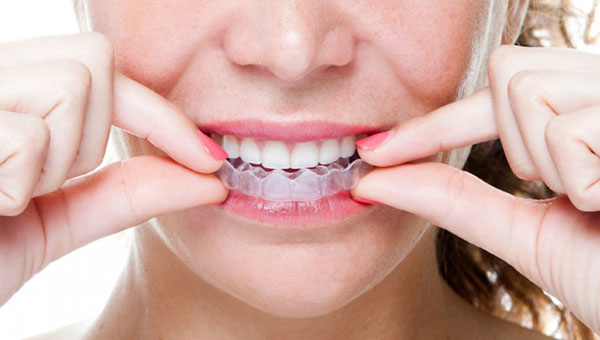 Hình thức niềng răng invisalign là gì?