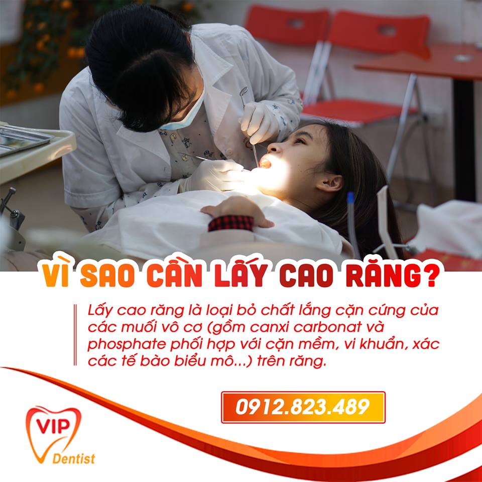 VÌ SAO CẦN LẤY CAO RĂNG?