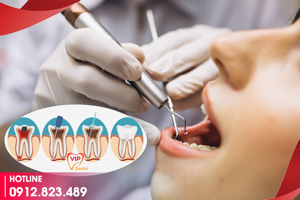 VÌ SAO NÊN ĐIỀU TRỊ TỦY TẠI VIP DENTIST?