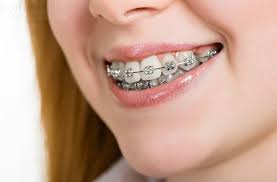 Niềng răng khắc phục răng hô, răng mọc lệch