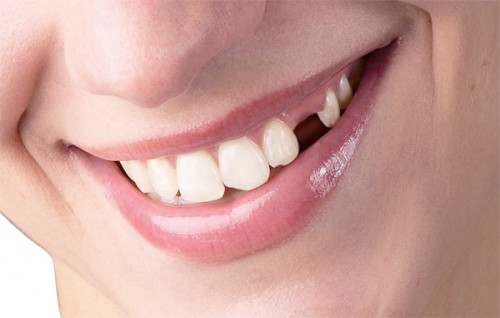 4 hệ quả của việc mất răng ít người biết